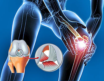 LESIÓN EN EL LIGAMENTO CRUZADO ANTERIOR: ¿QUÉ ES Y CÓMO SE TRATA?